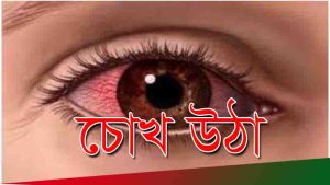 Read more about the article চোখ উঠলে করণীয় , জেনে নিন ঘরোয়া সমাধান